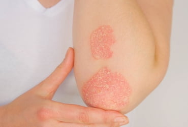 Psoriasis, enfermedad de la piel
