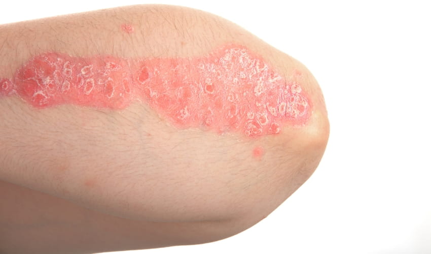 Qué es la psoriasis