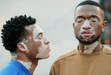 Vitiligo
