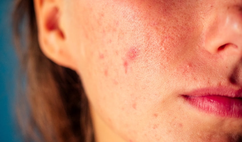 Qué son los puntos rubí