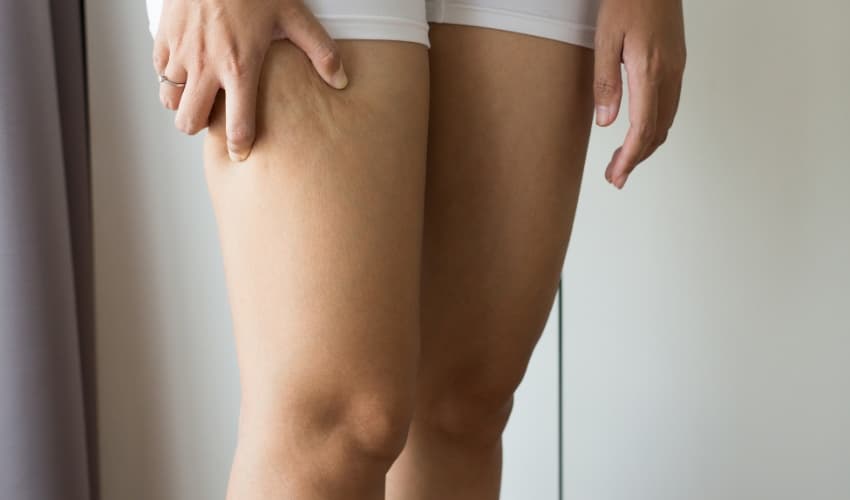 Síntomas de la celulitis