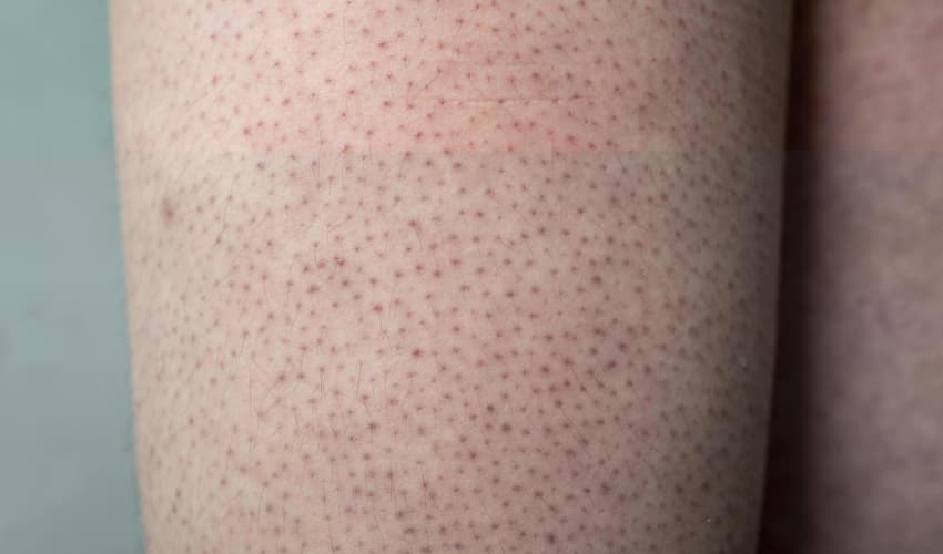 Causas de la queratosis pilaris
