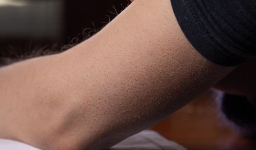 Qué es la queratosis pilaris