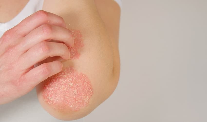Tratamiento Psoriasis