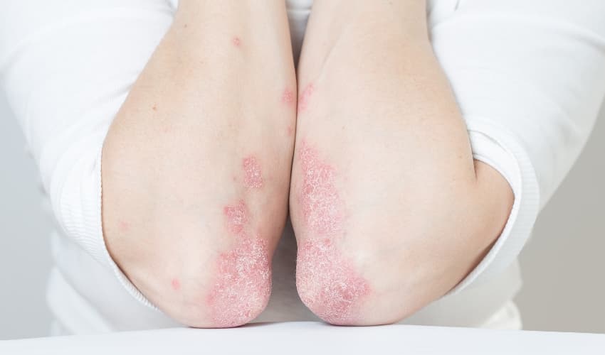 Cremas para Psoriasis