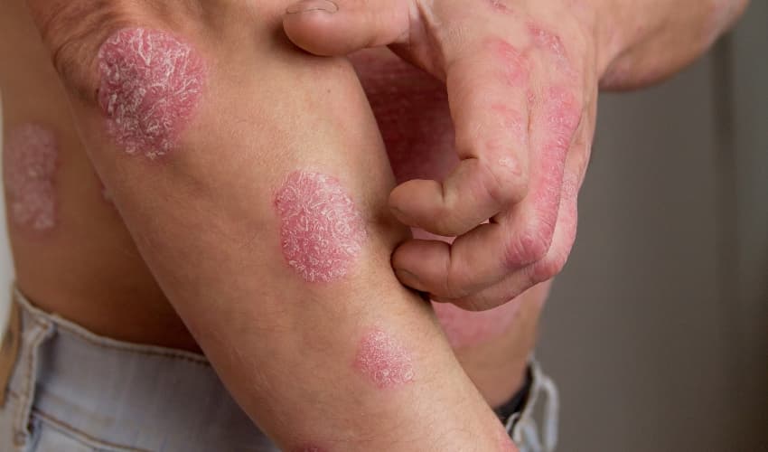 Cremas de farmacia para Psoriasis