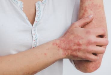 Tratamiento Psoriasis