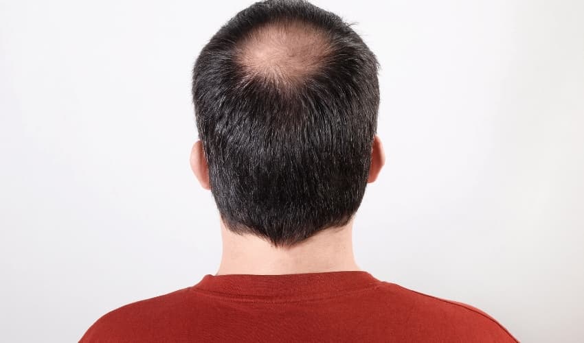 Minoxidil con Dutasterides. Prevención caída del cabello