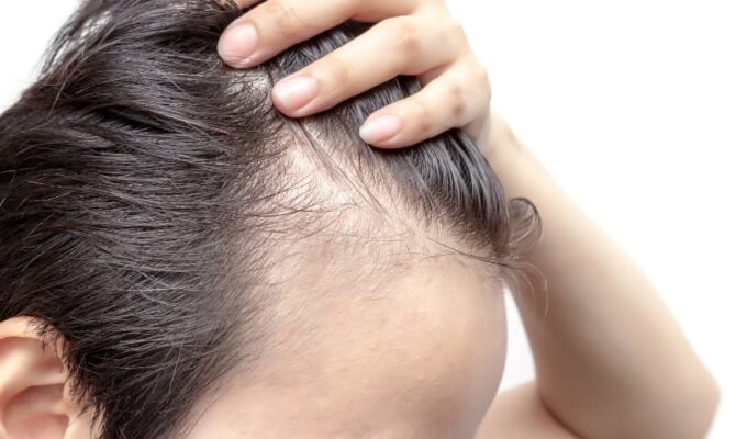 Minoxidil con Dutasterides. Prevención caída del cabello