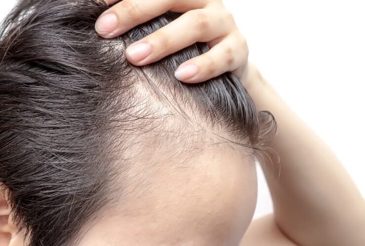 Minoxidil con Dutasterides. Prevención caída del cabello