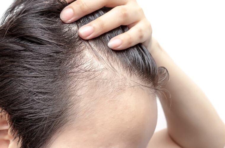 Minoxidil con Dutasterides. Prevención caída del cabello