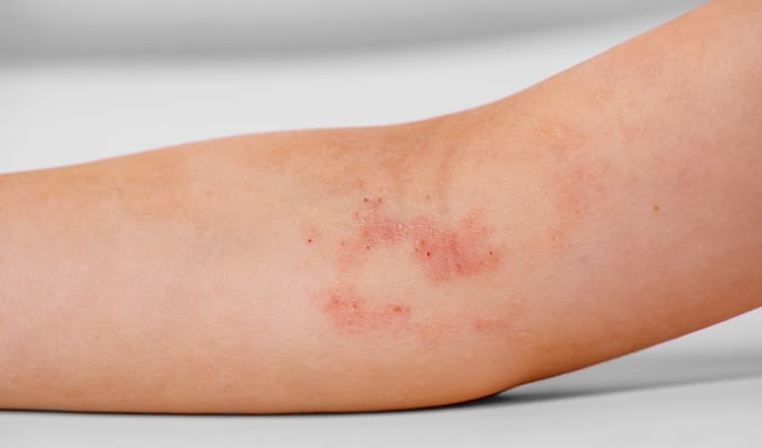 Síntomas de la dermatitis