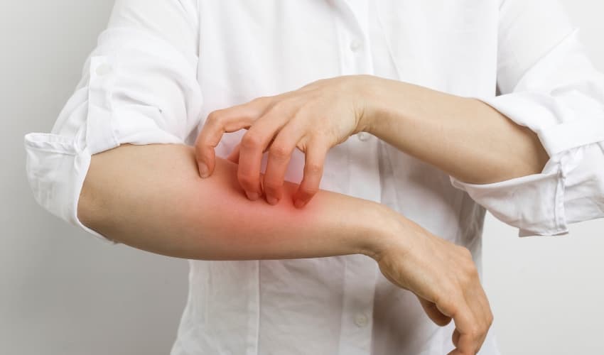 Prevenir y curar la sarna