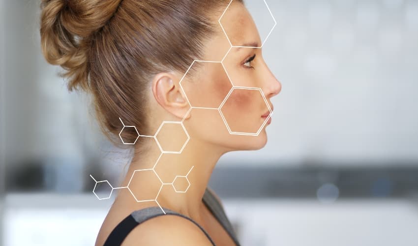 Melasma: Qué es y tratamientos