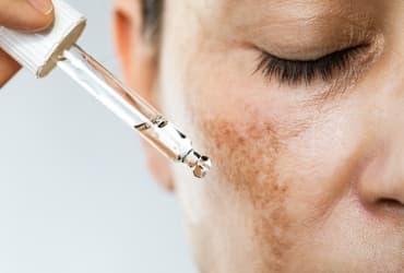 Melasma: Qué es y tratamientos