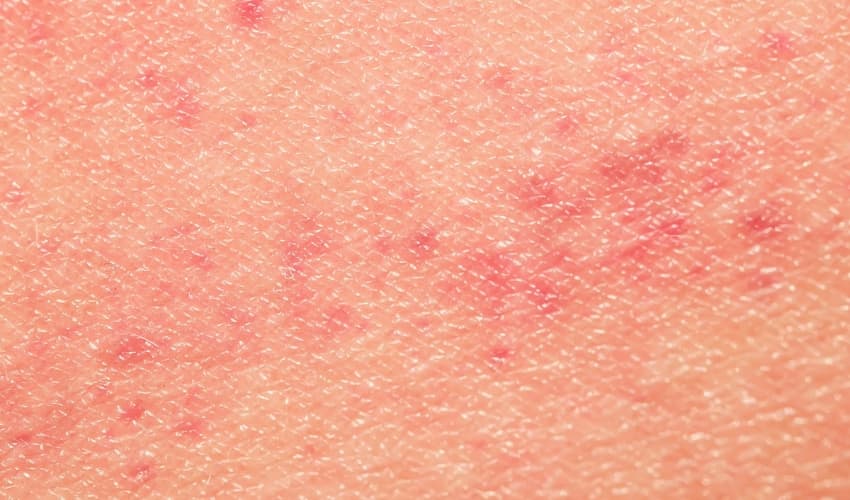 Infecciones en la piel