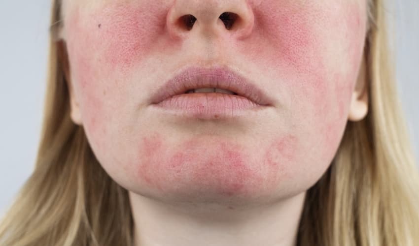 Causas y síntomas de la rosacea