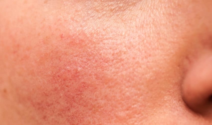Causas y síntomas de la rosacea
