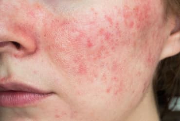 Causas y síntomas de la rosacea