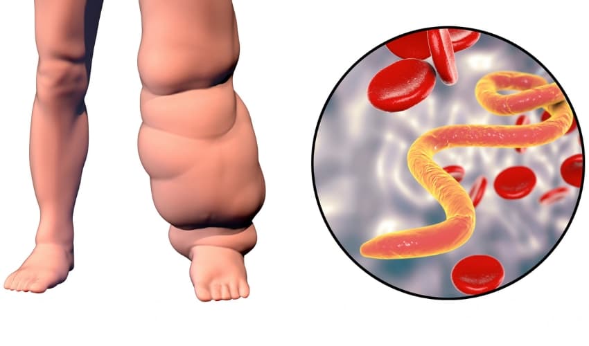 Retención de líquidos y mejorar la circulación