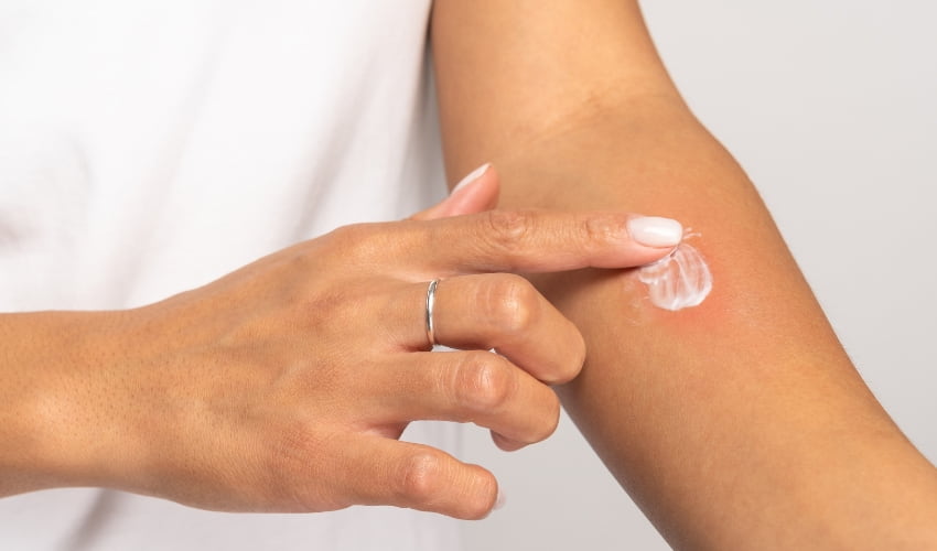 picadura insectos verano