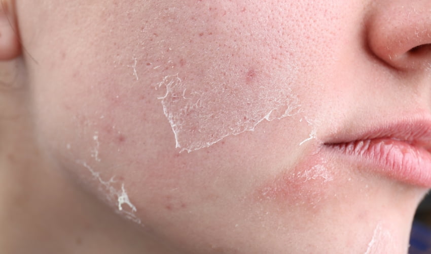 Piel seca en invierno